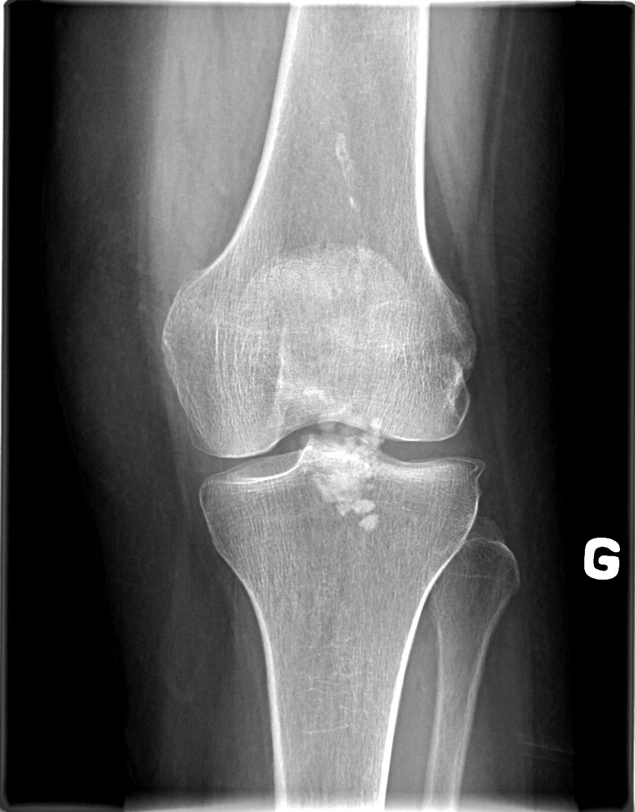 Calcific bursitis - superficial infrapatellar | Image | Radiopaedia.org