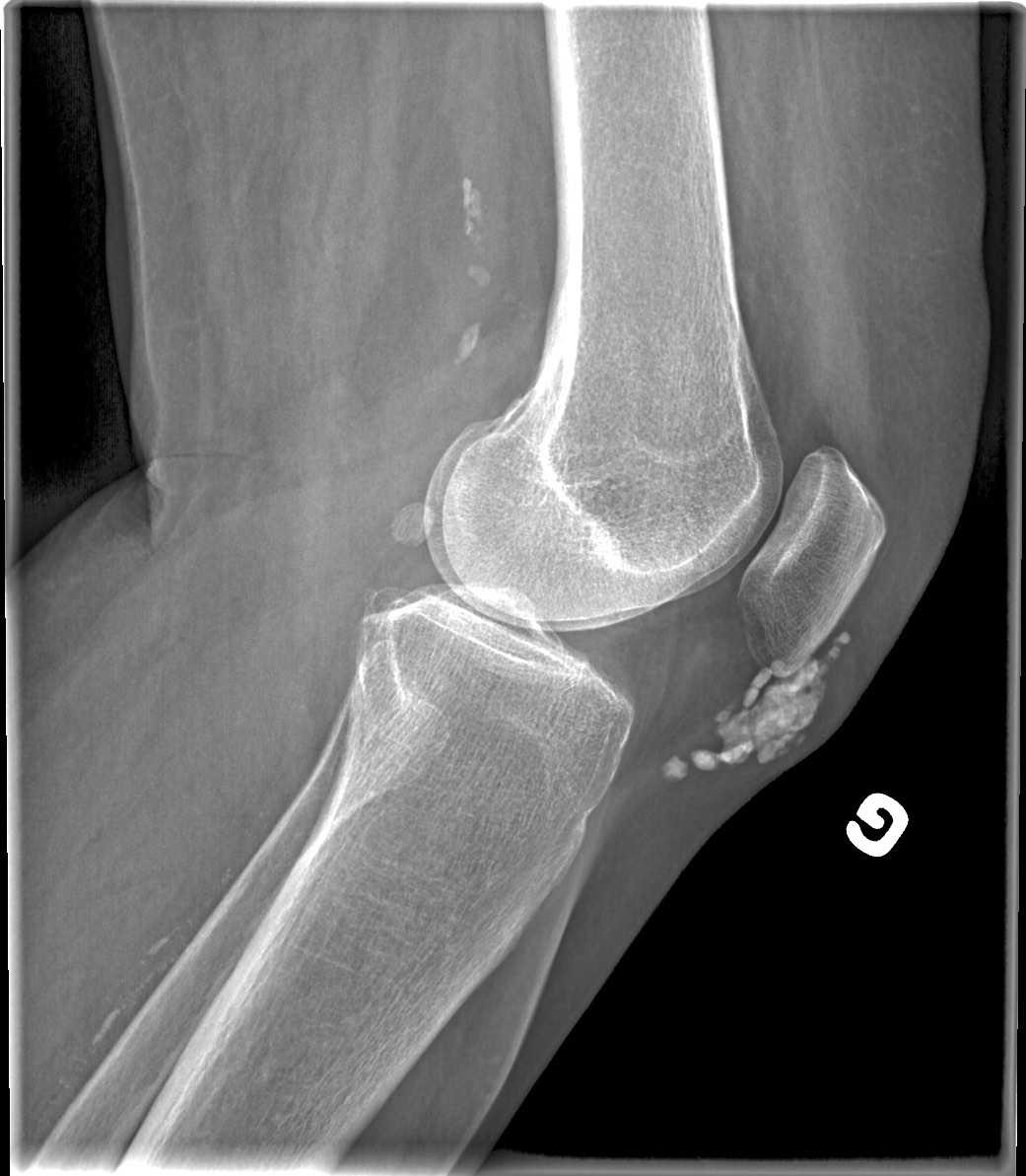 Calcific Bursitis Causes Signs And Symptoms Diagnosis And Treatment ...