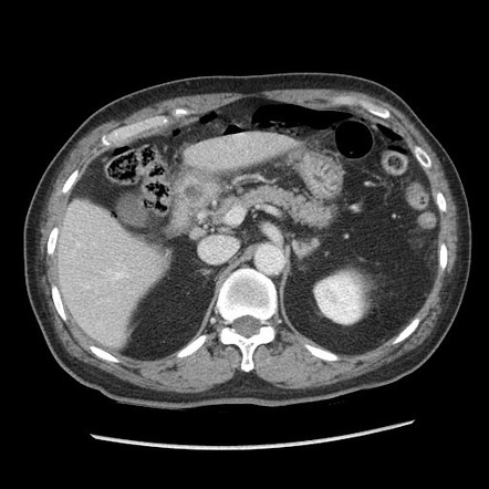 Perforated Peptic Ulcer X Ray