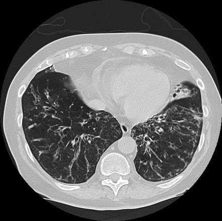 Alpha-1-antitrypsin deficiency | Image | Radiopaedia.org