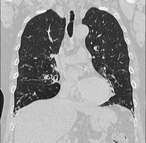 Alpha-1-antitrypsin Deficiency | Image | Radiopaedia.org