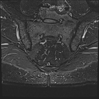 Denervation atrophy of left gluteus minimus and tensor fascia lata ...