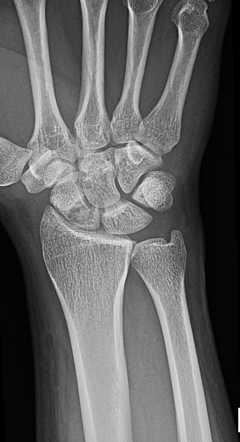 Scaphoid fracture | Radiology Reference Article | Radiopaedia.org