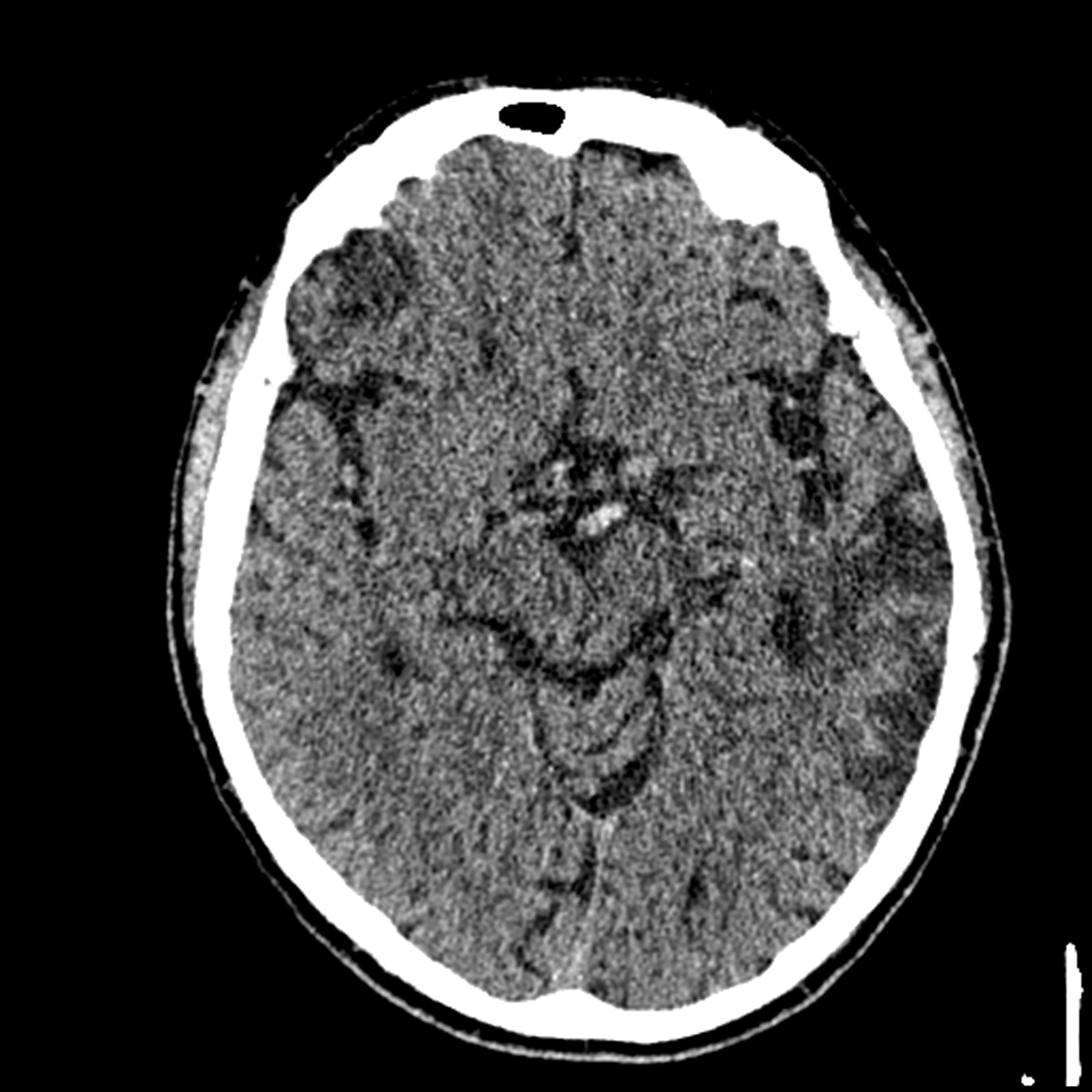 Acute P1 Occlusion With Pca Ischemia Penumbra (ct Perfusion) 