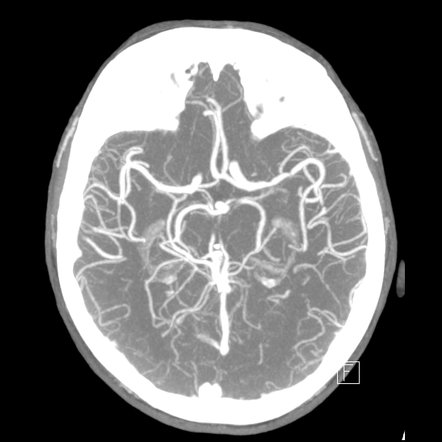 Acute P1 occlusion with PCA ischemia penumbra (CT perfusion) | Image ...