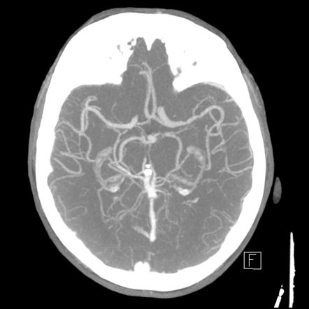 Acute P1 occlusion with PCA ischemia penumbra (CT perfusion) | Image ...