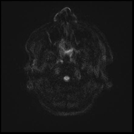 Acute P1 occlusion with PCA ischemic penumbra (CT perfusion ...