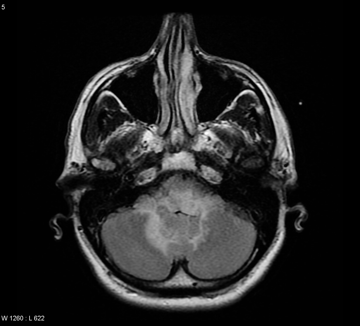 Primary CNS lymphoma - intraventricular | Image | Radiopaedia.org