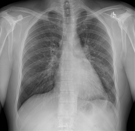 Left lower lobe consolidation | Radiology Reference Article ...