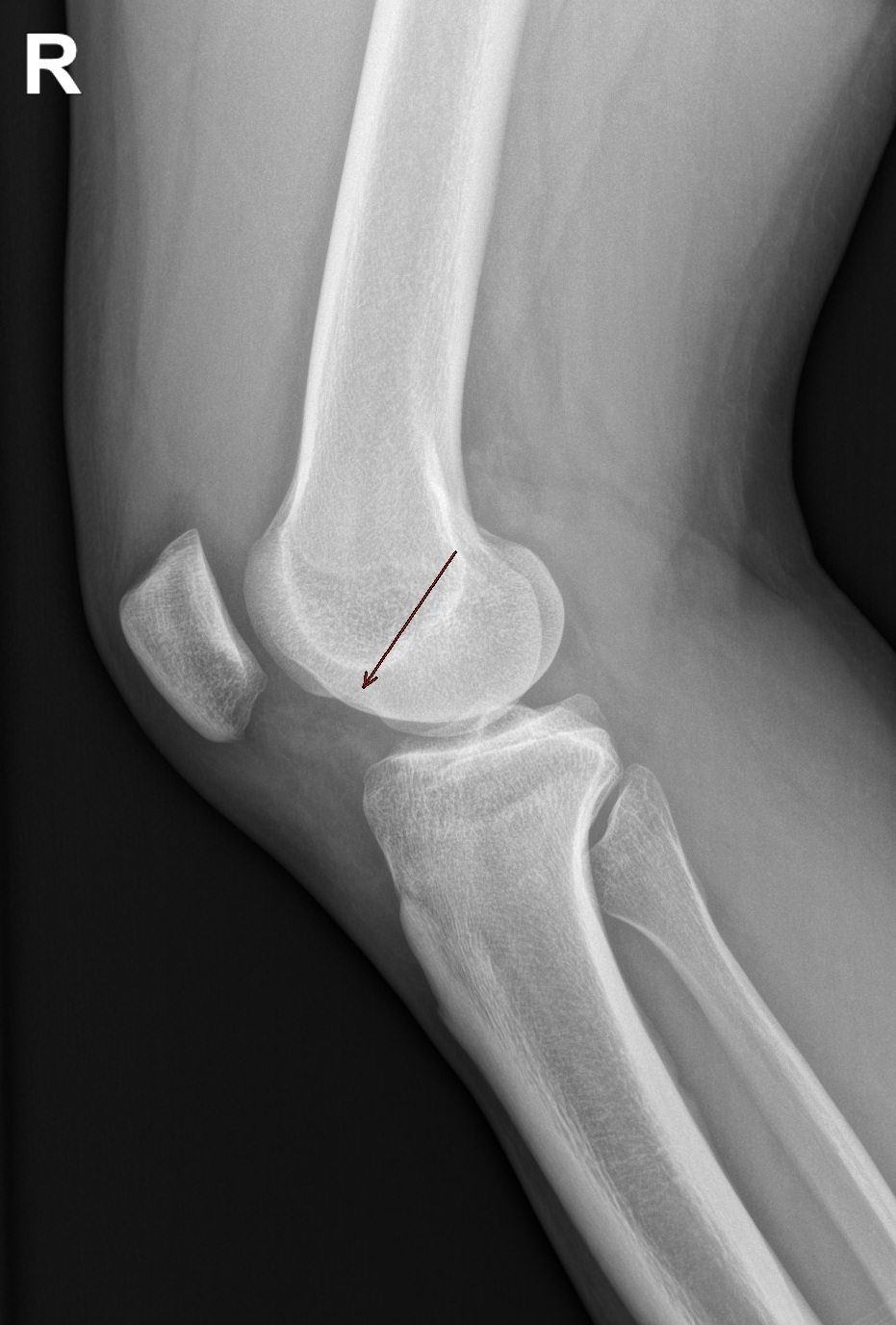 Segmentation Of The Lateral Femoral Notch Sign With Mri Using A New My XXX Hot Girl