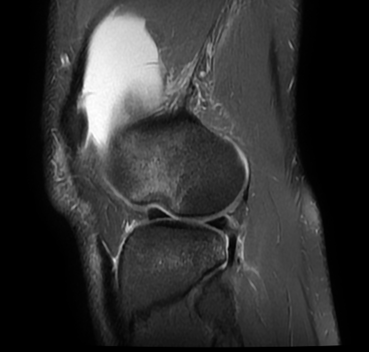 Lateral Femoral Notch Sign - Acl Tear 