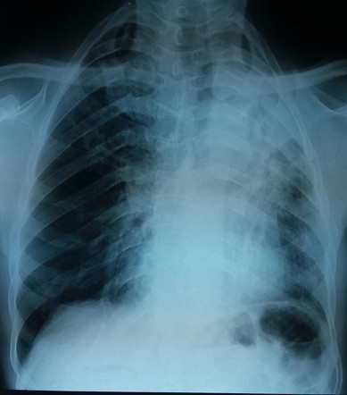 Pulmonary tuberculosis | Radiology Case | Radiopaedia.org