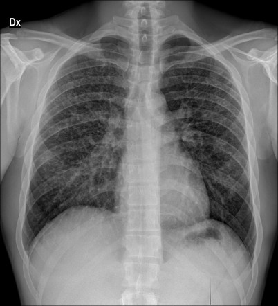 Pulmonary Langerhans cell histiocytosis | Image | Radiopaedia.org