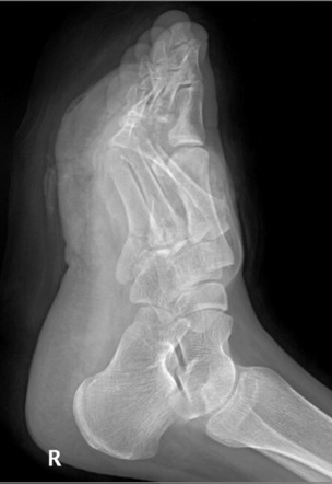 Divergent Lisfranc fracture-dislocation | Image | Radiopaedia.org