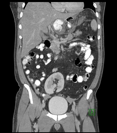 Ectopic kidney | Radiology Reference Article | Radiopaedia.org