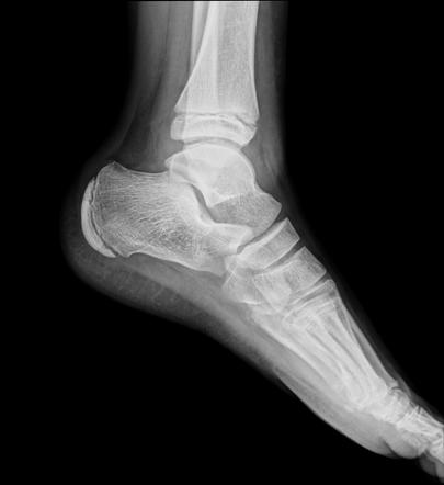 Apophysis of the fifth metatarsal | Radiology Case | Radiopaedia.org