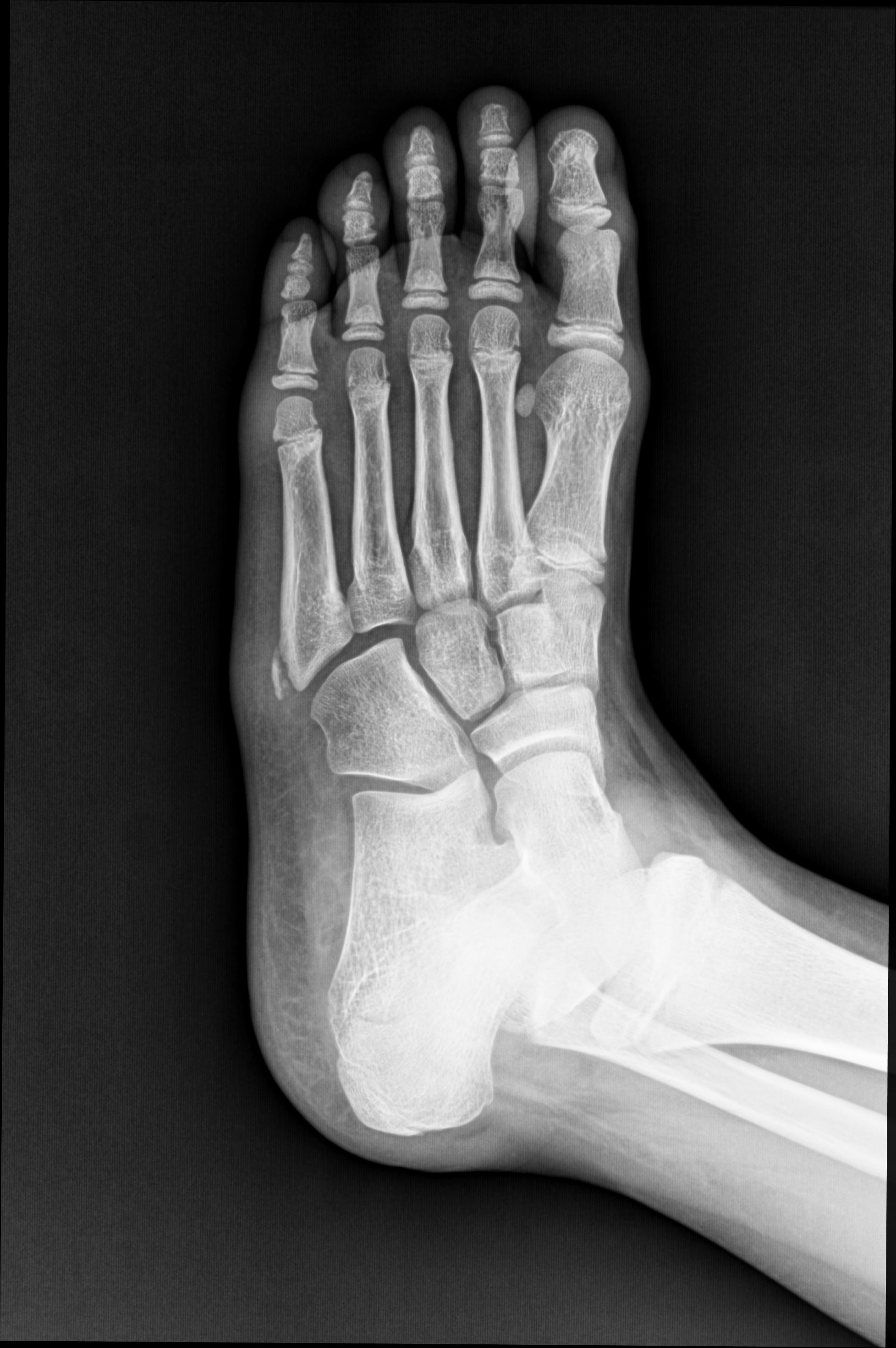 Apophysis of the fifth metatarsal | Image | Radiopaedia.org