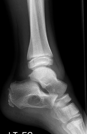 Unicameral Bone Cyst Calcaneus Surgery