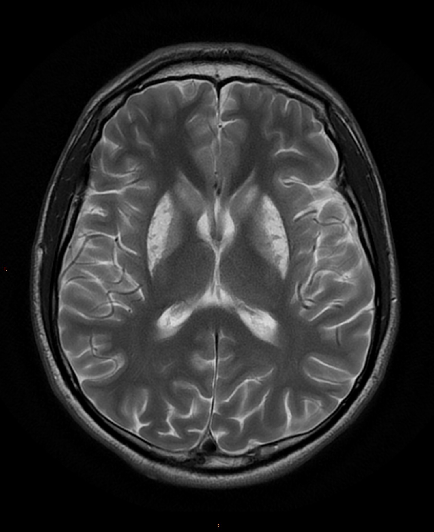 Hypoxic ischemic encephalopathy | Image | Radiopaedia.org