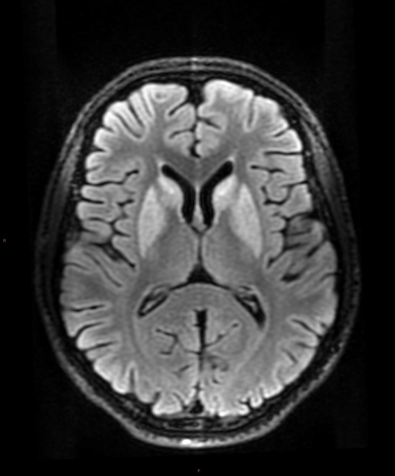 Hypoxic ischemic encephalopathy | Image | Radiopaedia.org