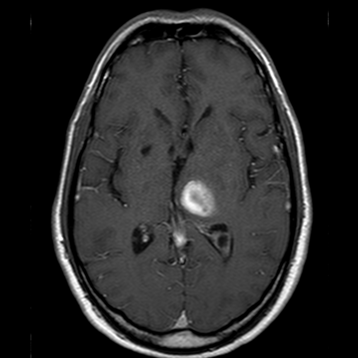 Hypertensive Intracerebral Hemorrhage 