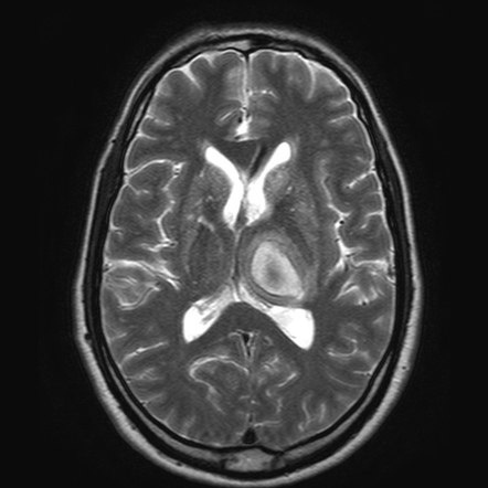 Hypertensive intracerebral hemorrhage | Image | Radiopaedia.org