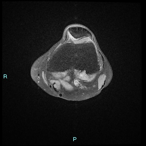 Solitary nodule of pigmented villonodular synovitis | Image ...