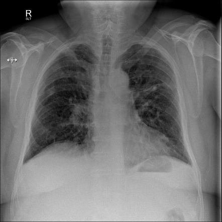 Pneumoperitoneum | Radiology Case | Radiopaedia.org