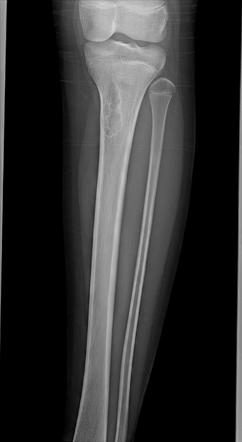 Non-ossifying fibroma - proximal tibia | Radiology Case | Radiopaedia.org