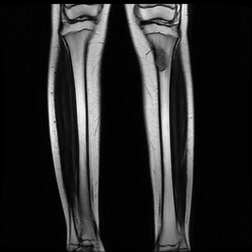 Non-ossifying fibroma - proximal tibia | Image | Radiopaedia.org