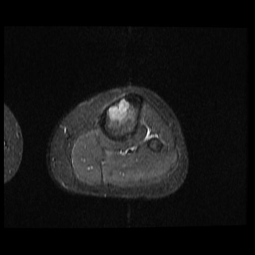 Non-ossifying fibroma - proximal tibia | Image | Radiopaedia.org