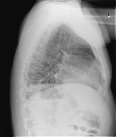 Pericardial Effusion 