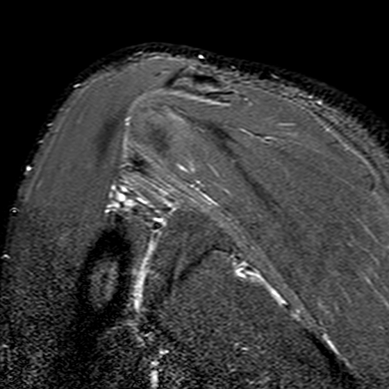 Teres Minor Atrophy Image