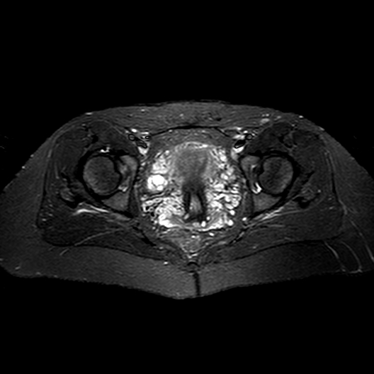 Acetabular labral tear hip | Image | Radiopaedia.org