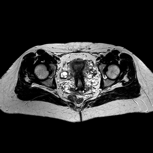 Acetabular labral tear hip | Image | Radiopaedia.org