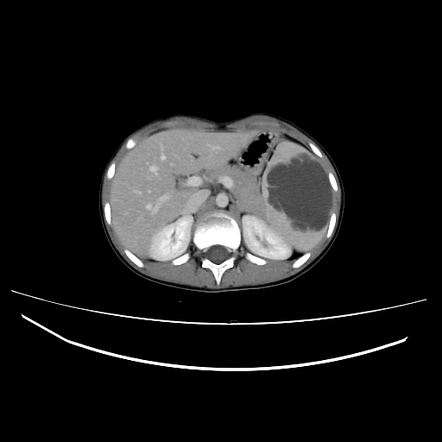 Splenic lymphangioma | Radiology Case | Radiopaedia.org