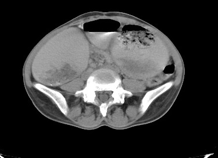 SMA syndrome and nutcracker phenomenon | Radiology Case | Radiopaedia.org