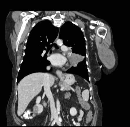 High-grade sarcoma of arm - metastatic | Image | Radiopaedia.org