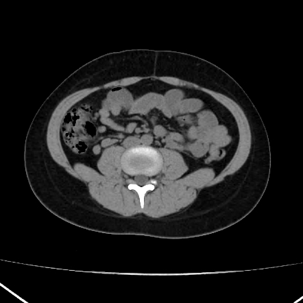 Mesenteric Adenitis Radiology Reference Article Radiopaedia Org