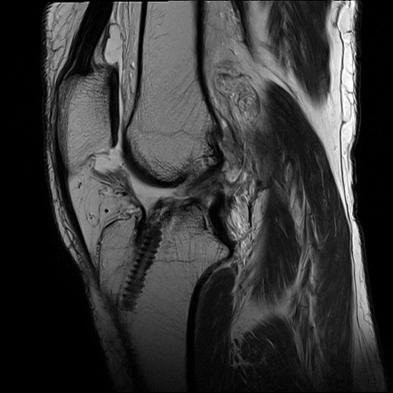 Complete tear of anterior cruciate ligament graft | Image | Radiopaedia.org