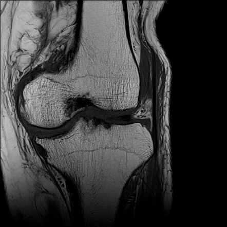 Complete tear of anterior cruciate ligament graft | Image | Radiopaedia.org