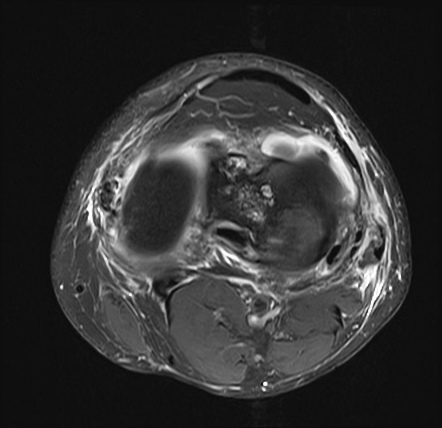 Complete tear of anterior cruciate ligament graft | Image | Radiopaedia.org