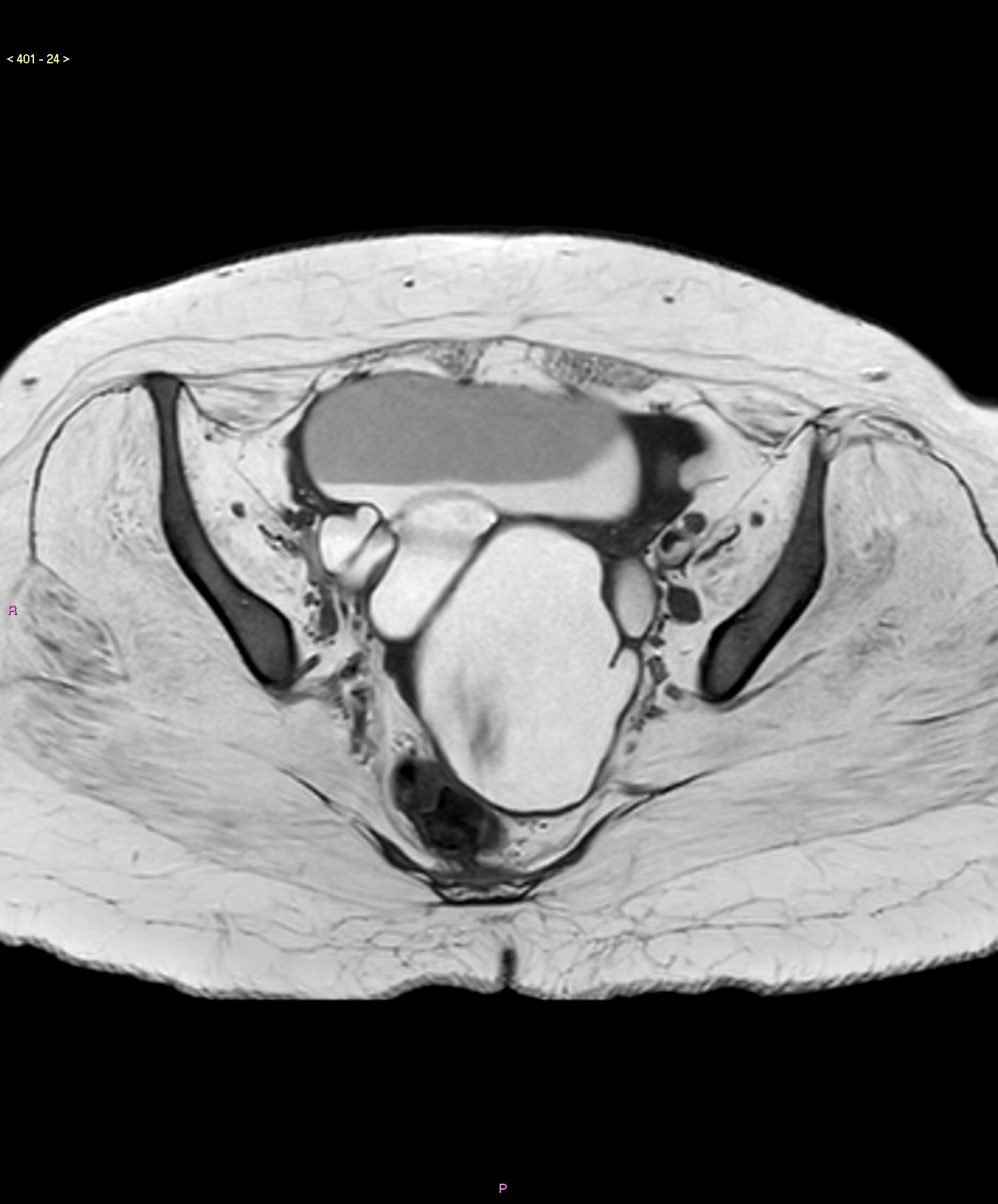 Endometriosis with bilateral kissing ovarian endometrioma | Image ...