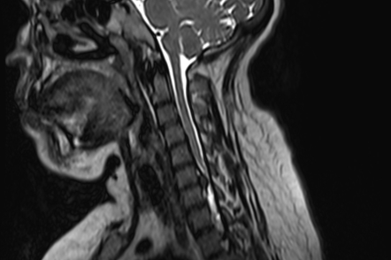 Foraminal disc extrusion | Image | Radiopaedia.org