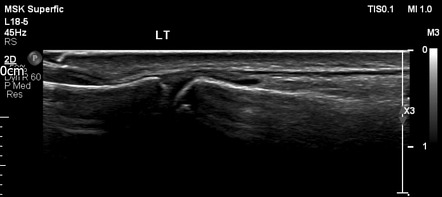 Extensor pollicis longus rupture | Image | Radiopaedia.org