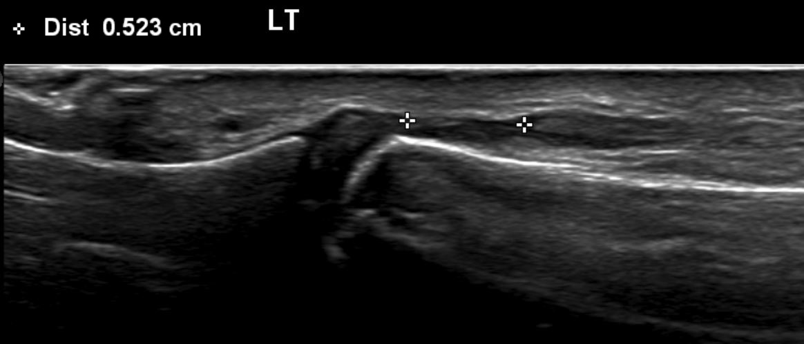 Extensor Pollicis Longus Rupture 