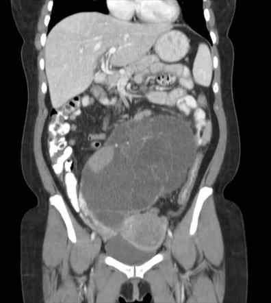 Ovarian mucinous cystadenoma | Image | Radiopaedia.org