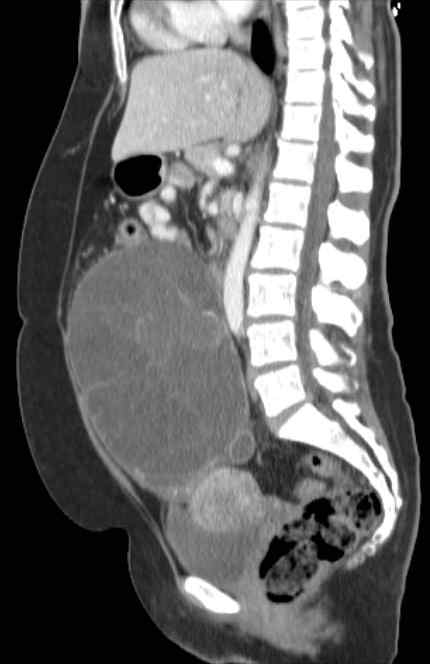 Ovarian mucinous cystadenoma | Image | Radiopaedia.org