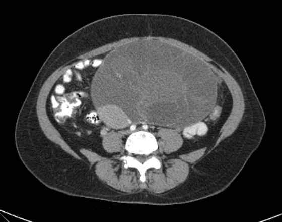 Ovarian Mucinous Cystadenoma Image 2722