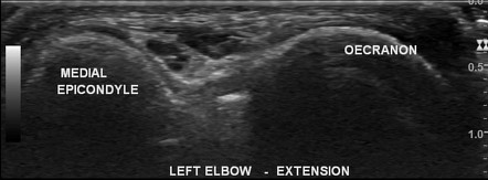 Superficial Thrombophlebitis And Anconeus Epitrochlearis 